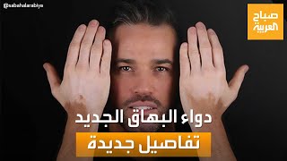 صباح العربية| كل ما تريد معرفته عن الدواء المنزلي الجديد لعلاج البهاق