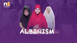 Albinism