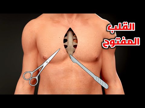 شاهد عملية القلب المفتوح      