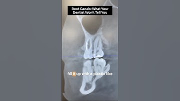 Root Canals: What your dentist won