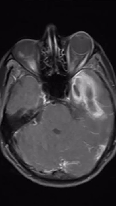 Brain abscess #radiology #neurology #CT #doctor #radiologist