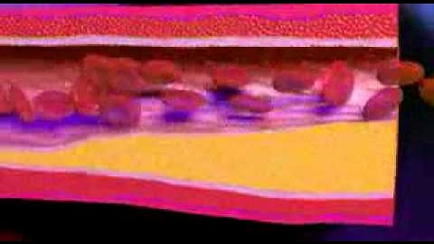 Congestive Heart Failure -  - CHF - Heart Failure Video - About.com_mpeg4