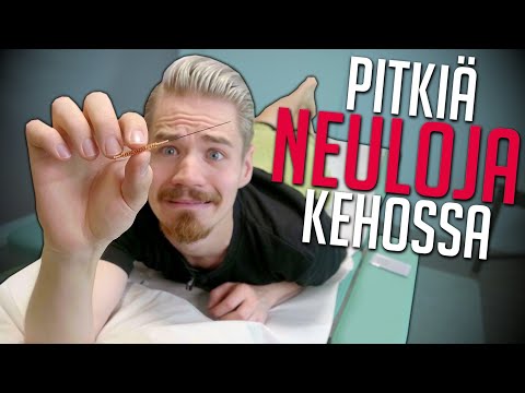 Video: Akupunktio Endometrioosille