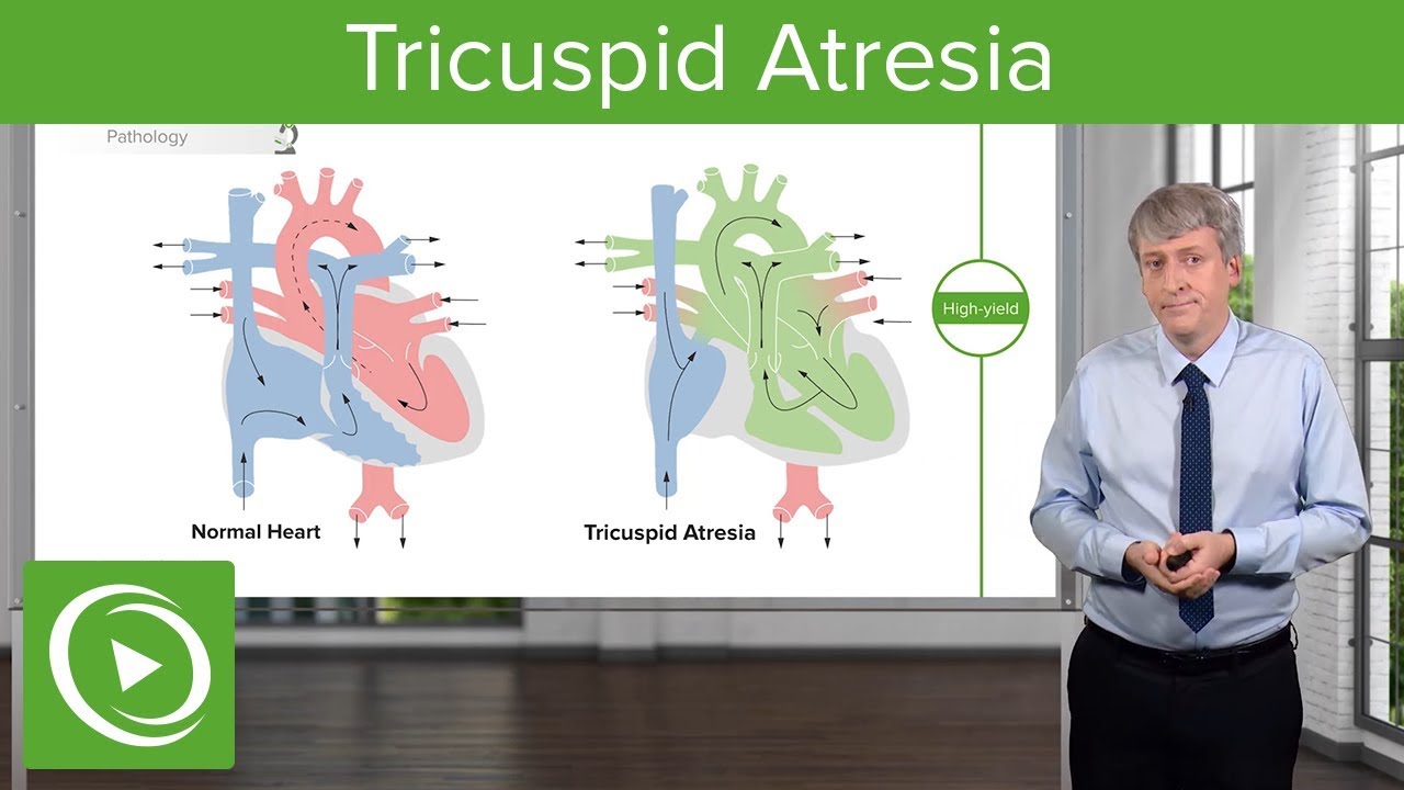 Tricuspid Atresia – Pediatric Cardiology | Lecturio