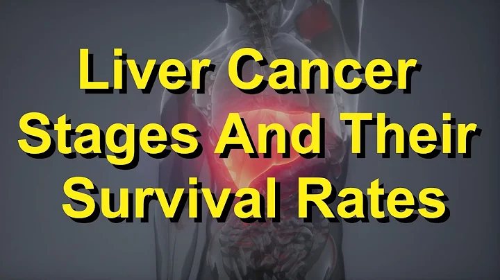 Liver Cancer Stages And Their Survival Rates - DayDayNews
