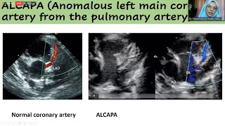 Case: Congenital Coronary Artery Anomalies