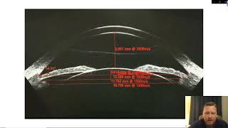 "Using ArcScan Insight 100 to Size STAAR Visian ICL" Webinar: Parkhurst NuVision, Dr. Mueller
