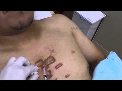 Using My Gopro: Treating Keloids With IL Steroids And Vbeam For Medical Education- NSFE.