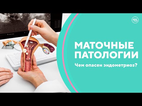 Маточные патологии. Миома, эндометриоз, удаление матки. Скажите, доктор!