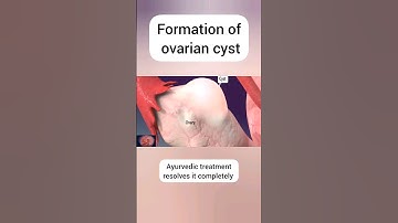 ovarian cyst #shorts #shortvideo #viral