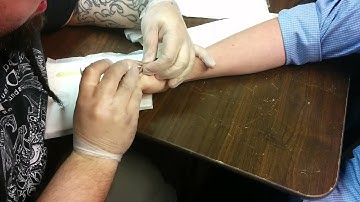 Implanting an xNT (NFC/RFID implant)