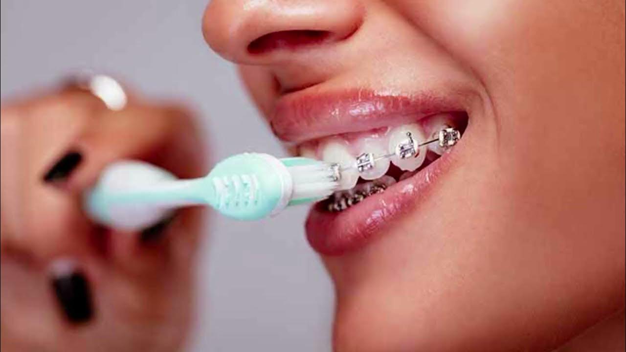 How Long Do Braces Take To Straighten Teeth YouTube