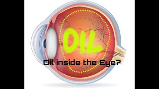 13: How long can you leave Silicone Oil inside the eye/ RETINAL DETACHMENT/ #retinaldetachment