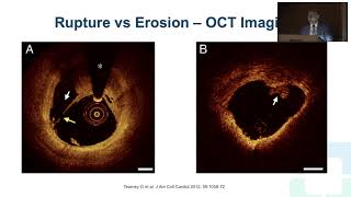 MINOCA in the Cath Lab: Mistakes and Misgivings - Khalid Ziada