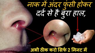 नाक में फुंसी का इलाज Boils in nose causes, symptoms and treatment in hindi