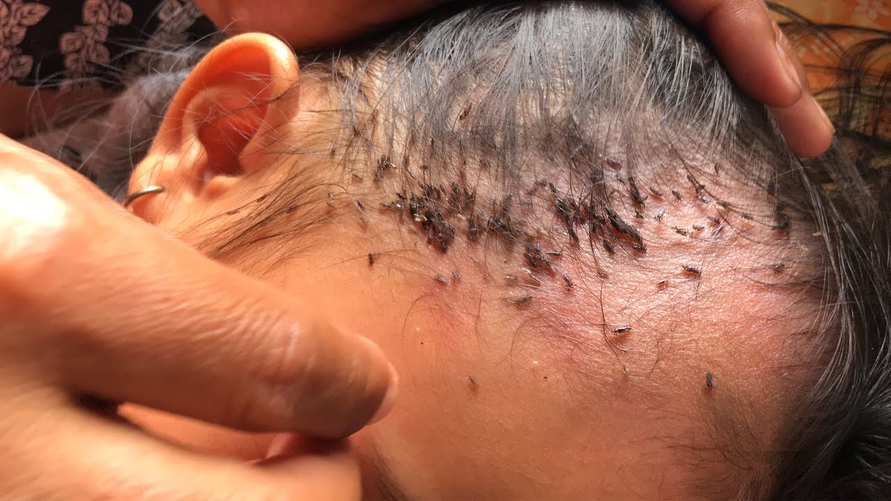 Removing Thousands Of Lice From Long Hair  How To Remove It