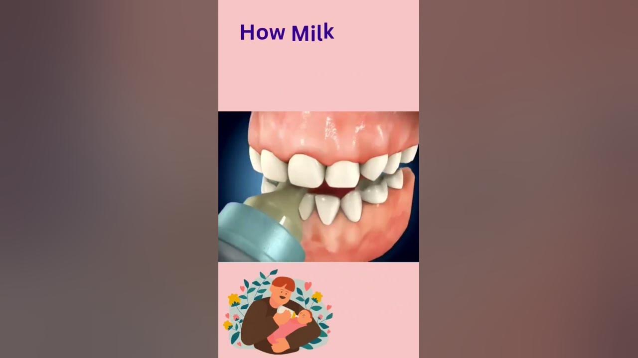 How does Baby Bottle  Tooth Decay happen🍼#baby#milk#teeth#decay #cavity #shorts #dentist #babycare