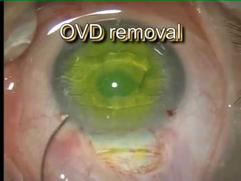 Sandwich Technique for Implantation of iris-fixated PIOL
