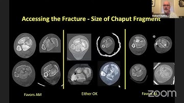 Tibial Pilon fractures from the Harborview