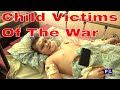 Child victims of Russia - Ukraine War In Donetsk