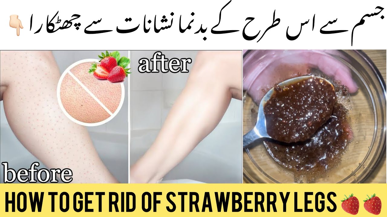 3 Ways to Get Rid of Leg Acne - wikiHow