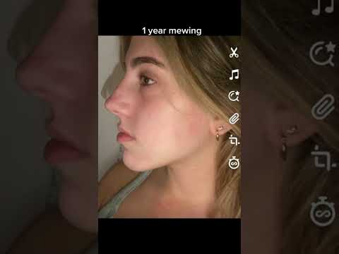 Female 1 year face transformation mewing #shorts #mewing