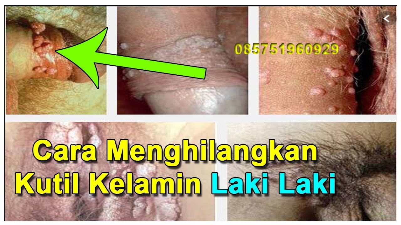 Cara Menghilangkan Kutil Kelamin Laki Laki - YouTube