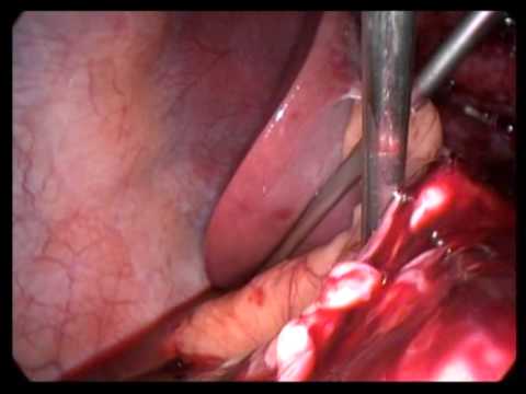 Lap  Cholecystectomy Unedited 366  Severe Acute GB Management Of Omental Bleeding