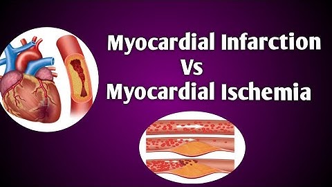 Difference Between Myocardial Infarction And Myocardial Ischemia || God