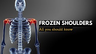 Frozen Shoulder, Causes, Signs and Symptoms, Diagnosis and Treatment.