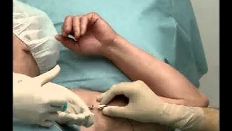 Dr  Abofadi / Gaza Strip Perivascular Axillary Brachial Block