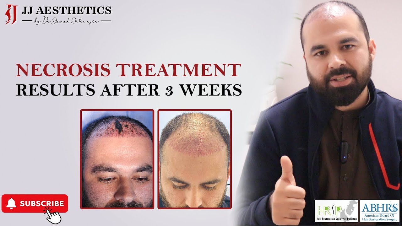 Treatment of scalp necrosis in 3 weeks Side effects of hair