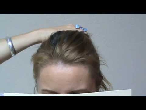 woman-hair-transplant-restoration-surgery-before-after-result-bald-high-hairline-www.mhtaclinic.com