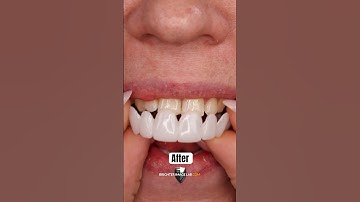 Snap On Veneers: Instant Smile Makeover