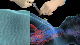 Accessing an implantable port training - 3D animation