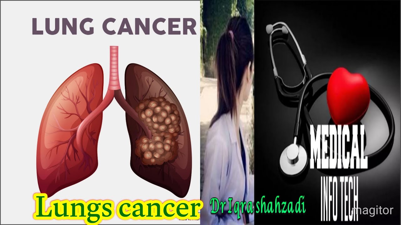 What Is Lungs Cancer YouTube what-is-lungs-cancer-youtube