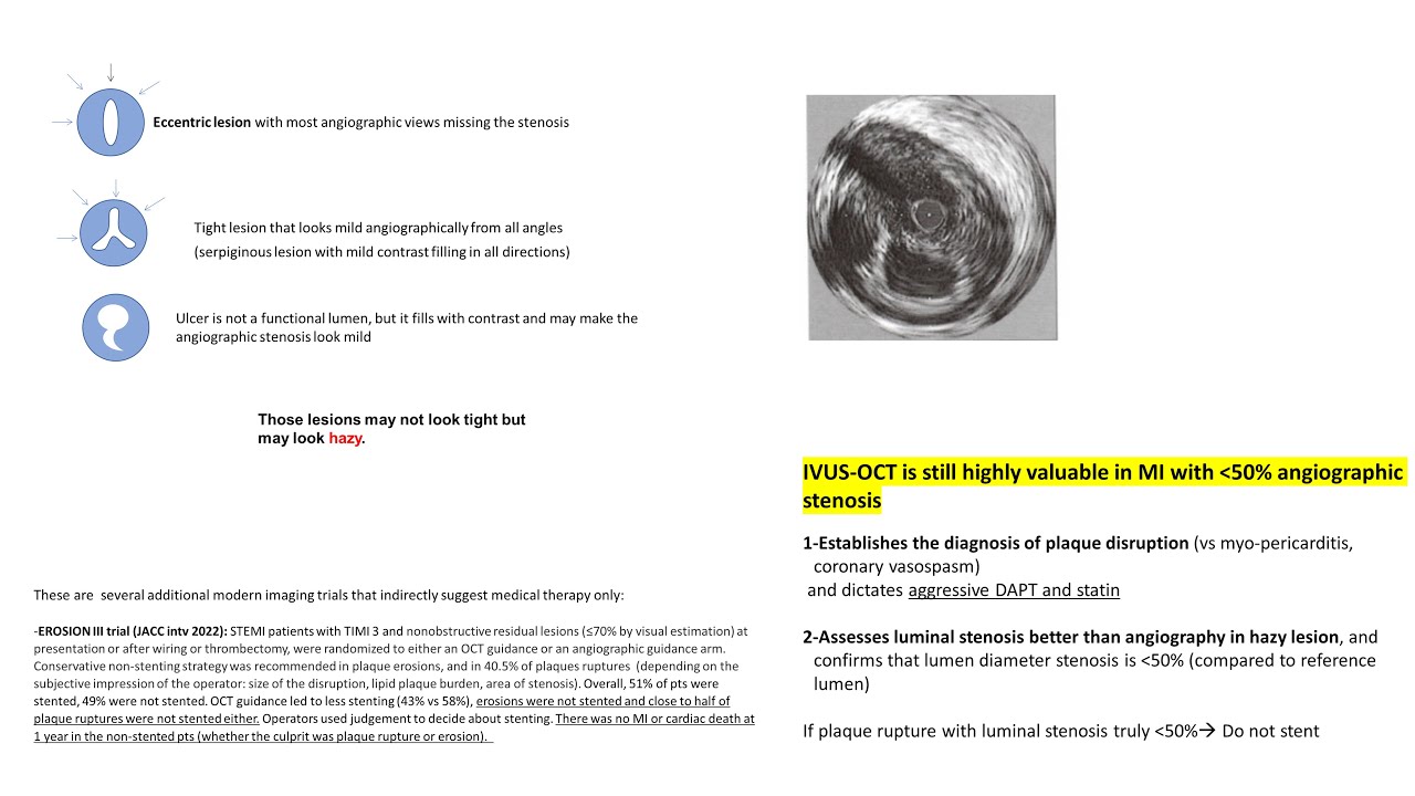 MI With Plaque Disruption On IVUS OCT But Stenosis Less Than 50 MI With Plaque Disruption On IVUS OCT But Stenosis Less Than 50