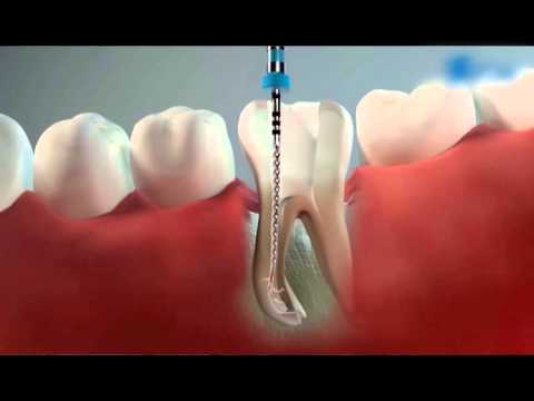 эндодонтия. лечение каналов зуба. гуттаперча. 3д- пломбирование.