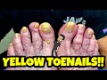 CUTTING INSANELY YELLOW TOENAILS WITH FUNGUS