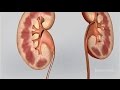 Kidney Stones Symptoms and Treatments