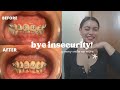MY PERFECT SMILE JOURNEY | LASER GINGIVECTOMY | GUM SURGERY |EXPERIENCE
