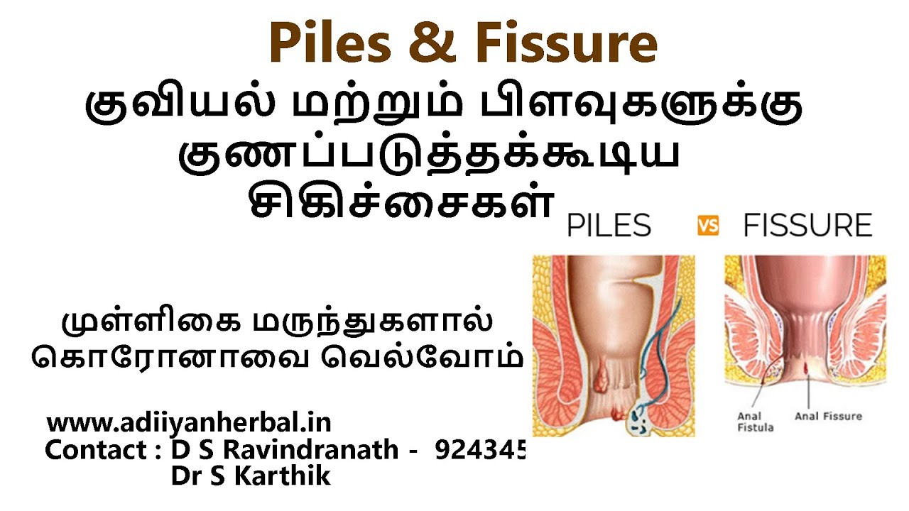 piles and fissures Herbal treatment curing piles and fissures YouTube