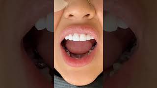 فينير الأسنان