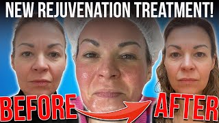 I tried the new exosomes microneedling facial and this is what happened by The Honest Channel 17,299 views 4 months ago 14 minutes