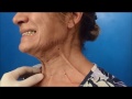 Botulinum toxin for neck rejenevation