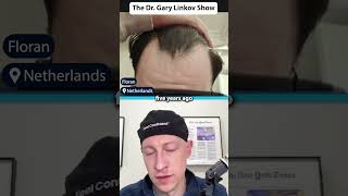 Are Genetics A Good Predictor Of Hair Loss?