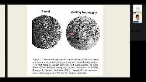 Audiological assessment & managemnt of Auditory Neuropathy Spectrum Disorder(ANSD)-research evidence