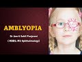 AMBLYOPIA ( lazy eye) EXPLAINED
