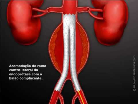 aneurisma da aorta abdominal - www.drcardozo.co...