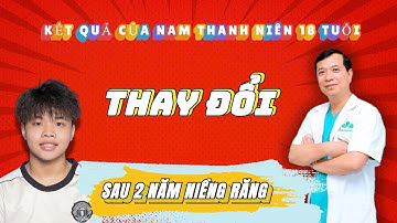 2 Năm Niềng Răng – Hành Trình Lột Xác Của Chàng Trai Trẻ | Nha khoa Quốc Tế Oswin